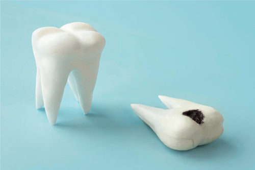 The Role of Genetics in Tooth Decay