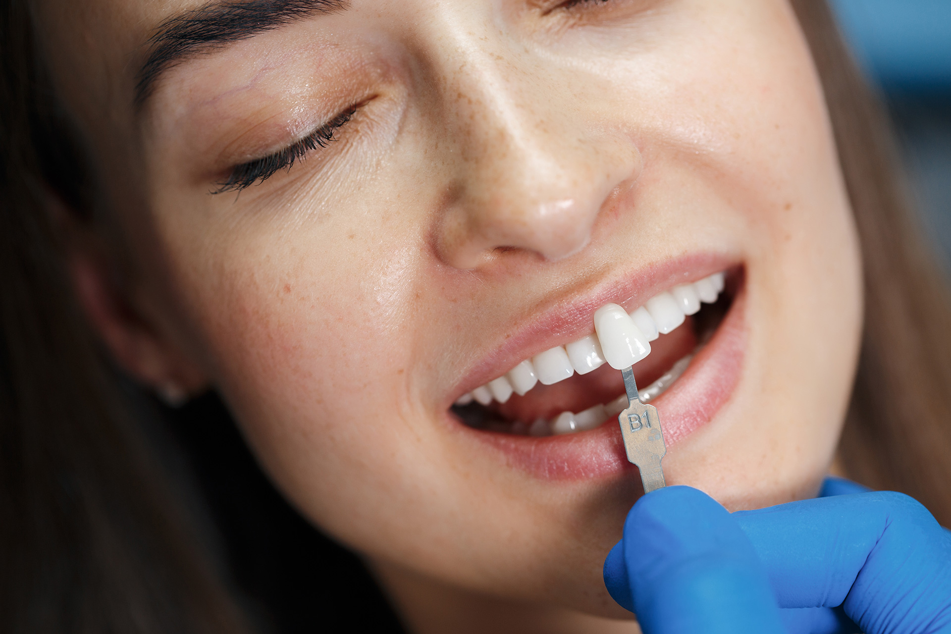 Veneer & Smile Design: Enhancing Your Smile with Precision