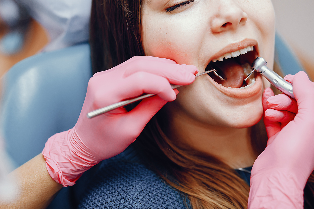 Inlay-Onlay Fillings: A Professional Guide