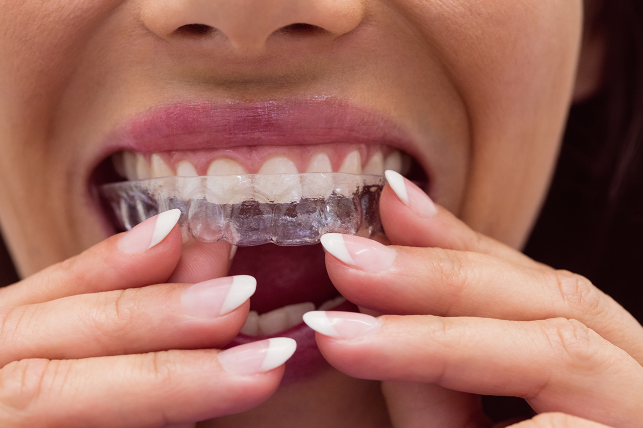 Clear Aligners (Invisalign): The Transparent Alternative to Traditional Braces
