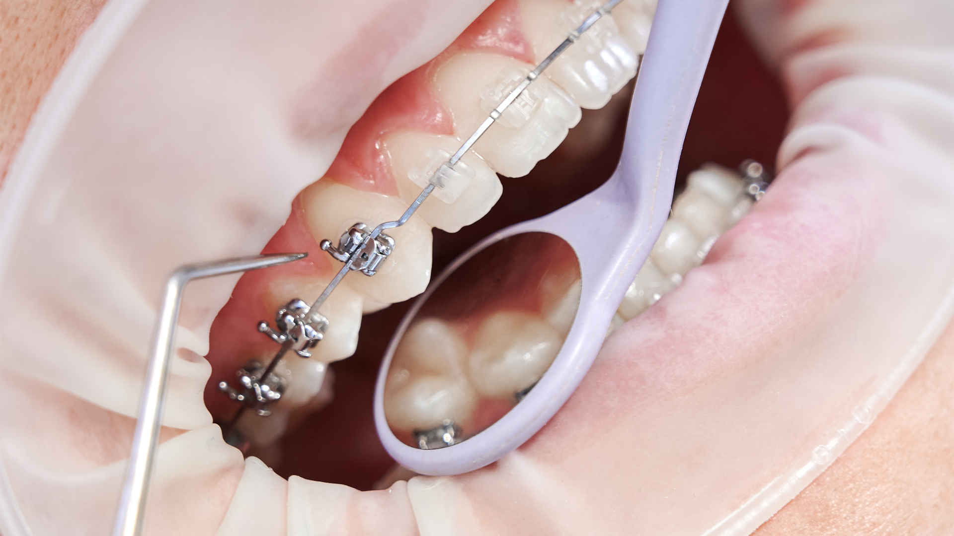 Orthodontic Treatment