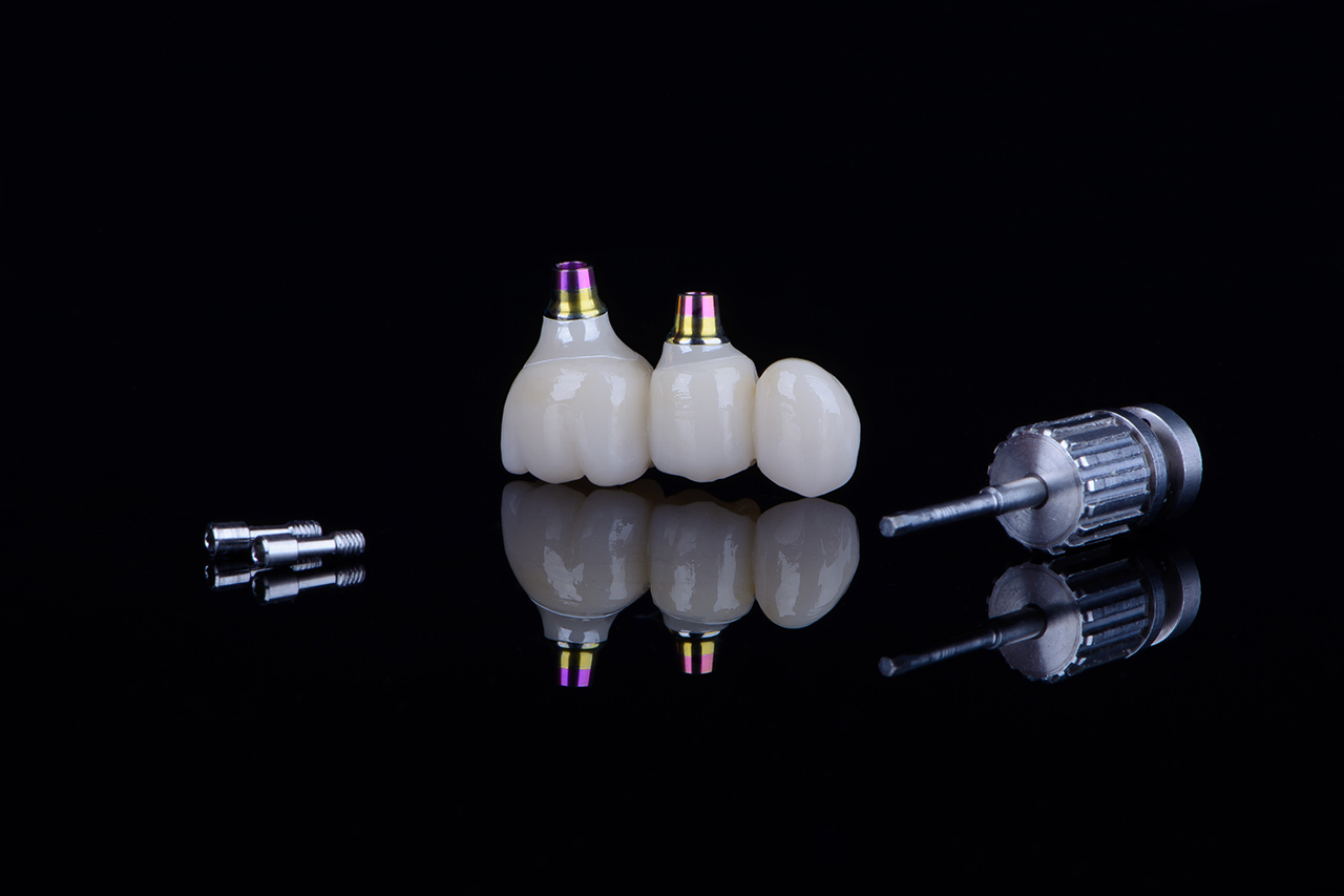 All-on-4 vs All-on-6 Implant Treatment Options: Which is Right for You?