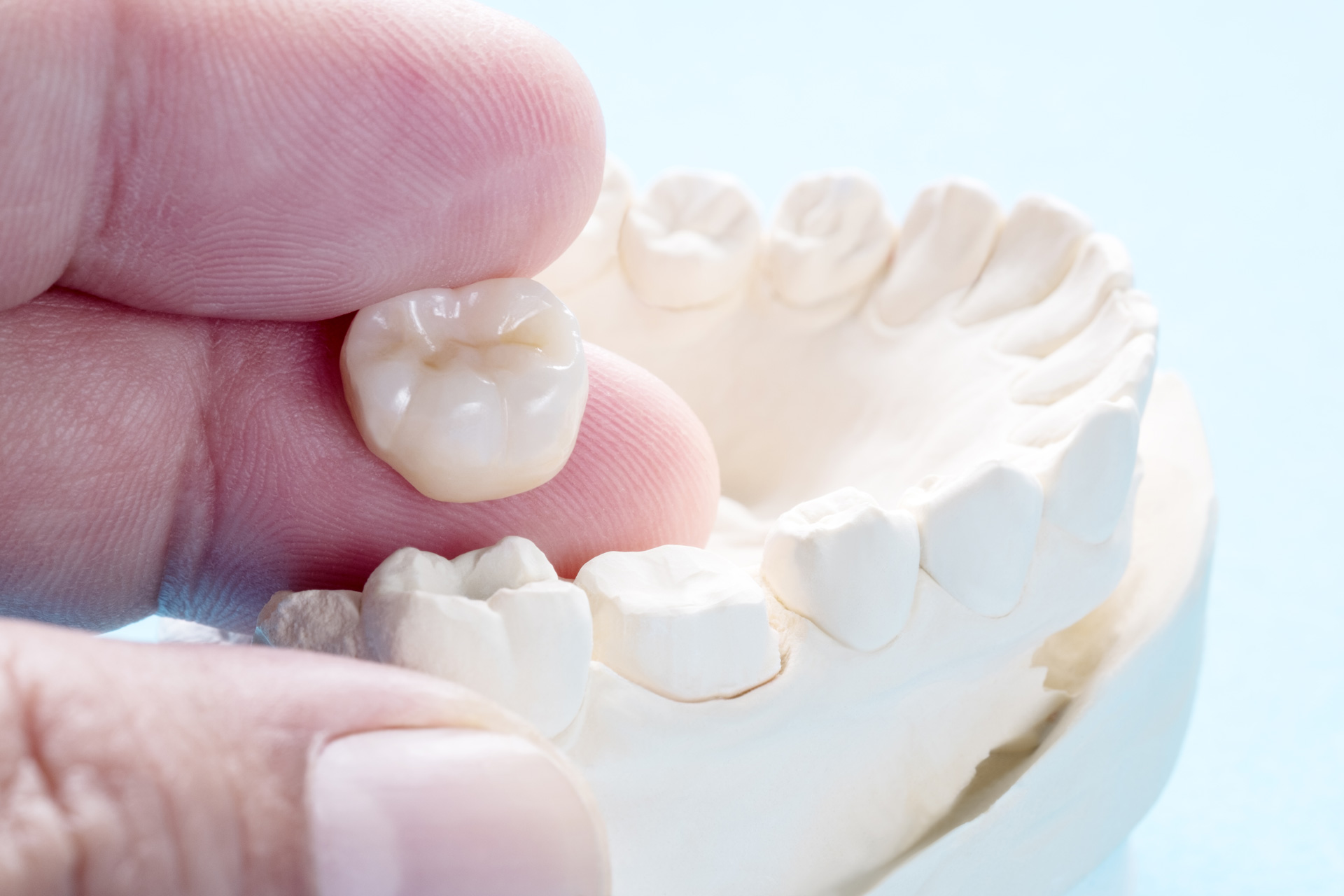 Zirconium Crowns